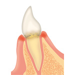 歯周病の進行